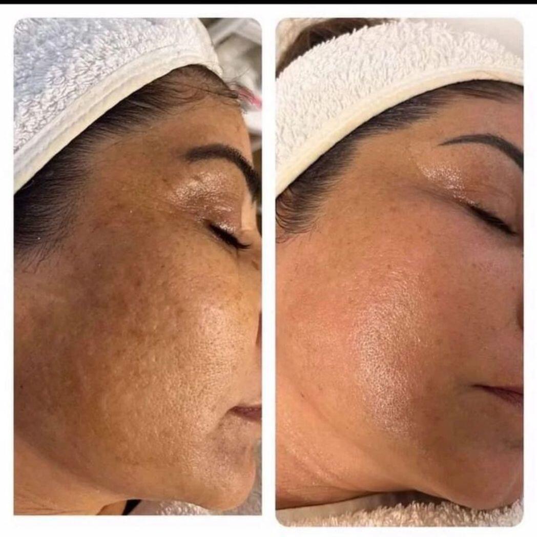 CREMA SKIN-CARE KOREANO 2% NIACINAMIDA ÁCIDO HIALURÓNICO - Chichicas